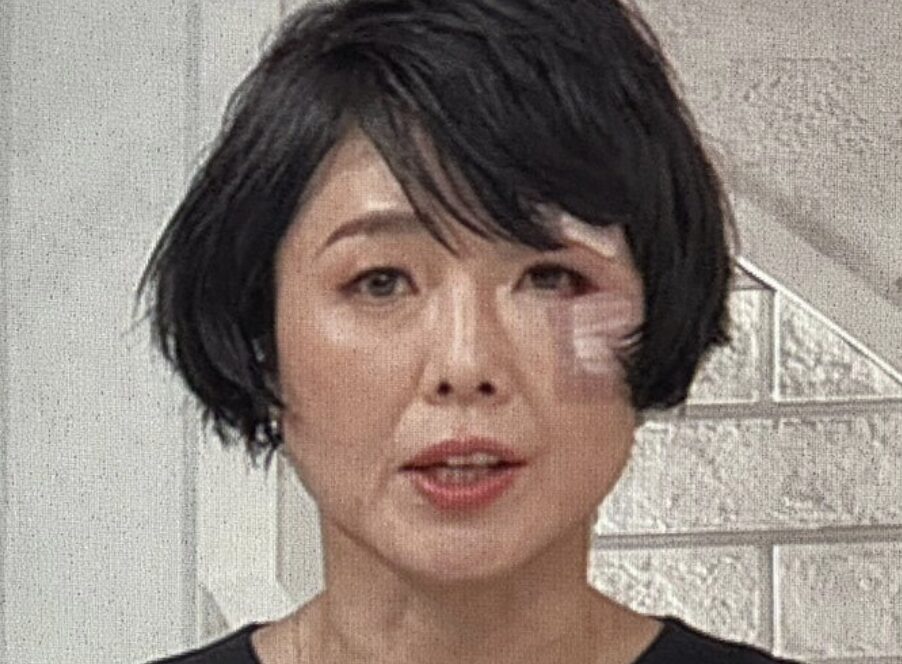 有働由美子が『news zero』に顔に怪我や傷だらけで出演